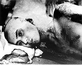 Survivor of the Hiroshima Atomic Bombing