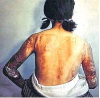 Survivor of the Hiroshima Atomic Bombing